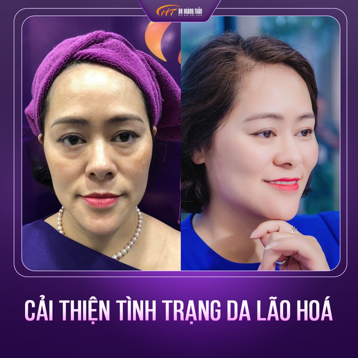 review tiêm BAP 5 điểm